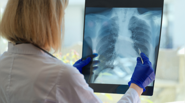 Lung cancer