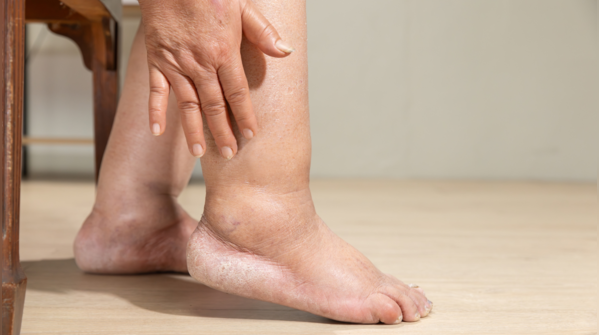 2. Swollen feet