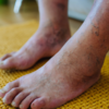 3. Discoloration of feet