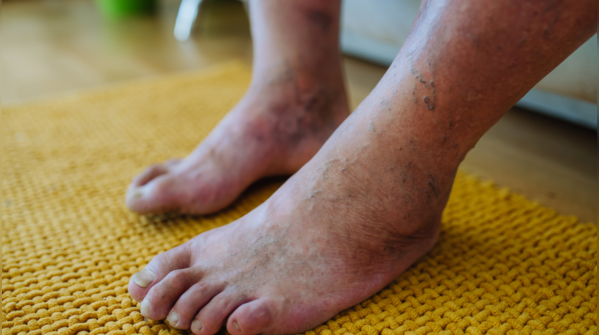 3. Discoloration of feet