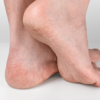 5. Cracked feet