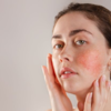 Reduces acne and inflammation