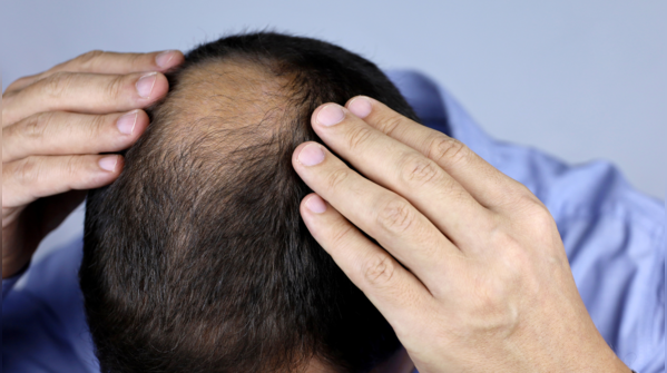 Baldness can be a result of high dihydrotestosterone (DHT)