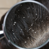 Persistent dandruff might be due to zinc deficiency