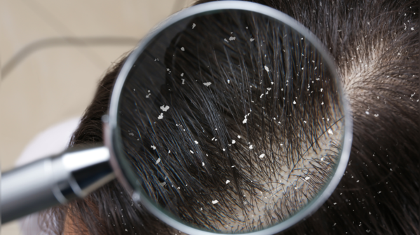 Persistent dandruff might be due to zinc deficiency