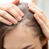 Hair thinning is often linked to iron deficiency