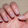 Nails that curve in like spoons or grow abnormally