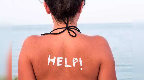 Pro tips for sunburn recovery