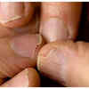 Hair fall/brittle nails