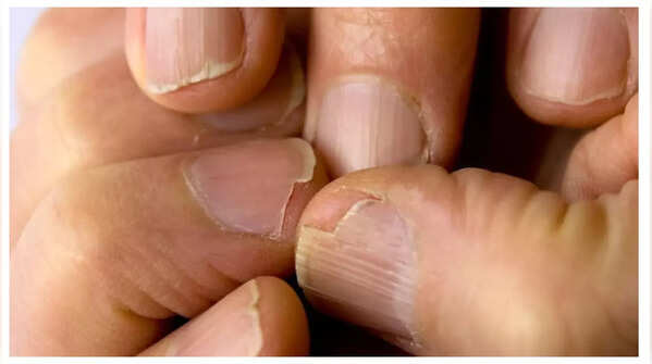 Hair fall/brittle nails