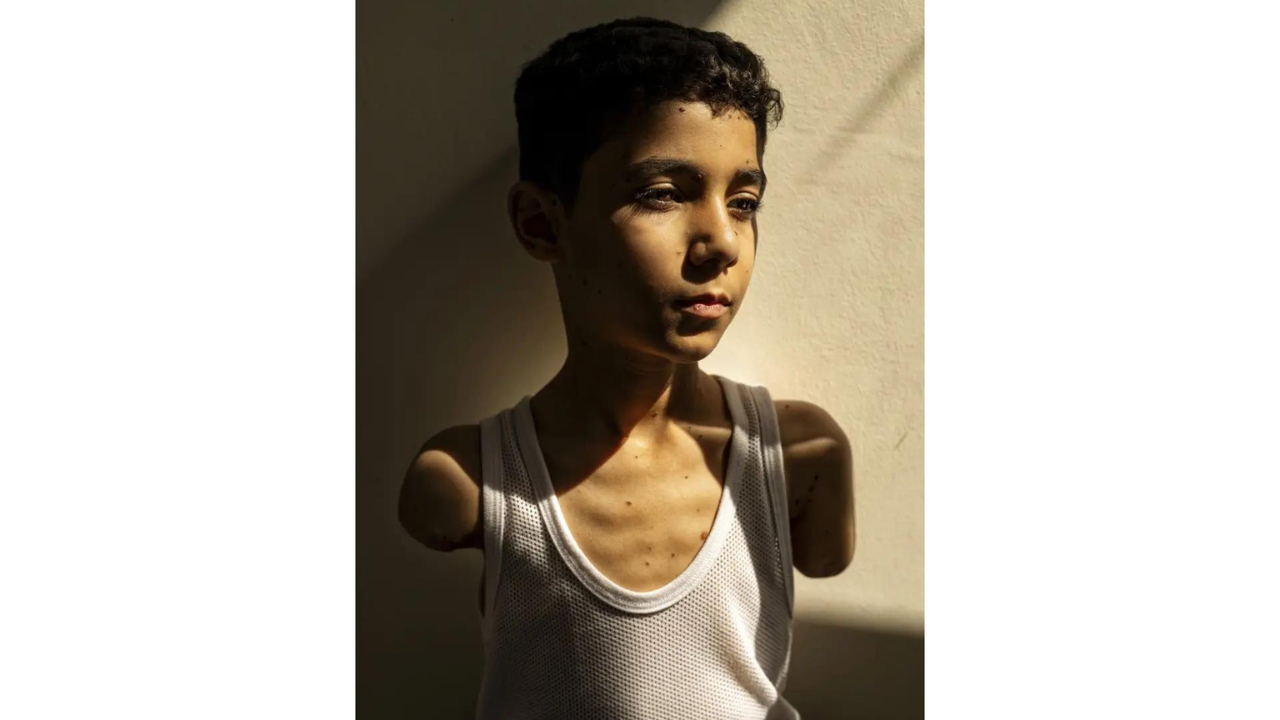 Photo of amputee Palestinian boy wins 2025 World Press Photo of the Year