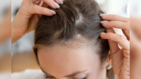 Traction alopecia