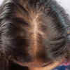 ​Androgenetic alopecia