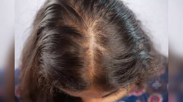 Androgenetic alopecia