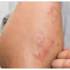 Skin changes around joints