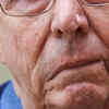 Face drooping 