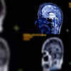 What is a stroke?