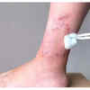 Poor Wound Healing