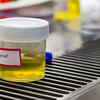 Blood in urine