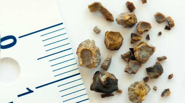 What is a kidney stone?