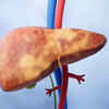 What is fatty liver disease