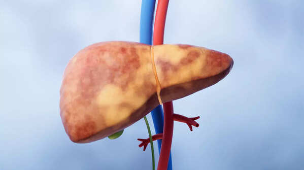What is fatty liver disease