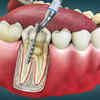 Article image for: What is a <i class="tbold">root canal</i> treatment?