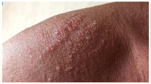 Sudden Clusters of Small Bumps or Rash-Like Lumps (Eruptive Xanthomas)