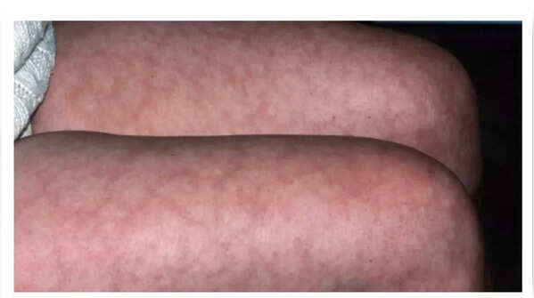 Blue or Purple Net-Like Patterns on the Skin