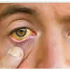 Skin Discoloration or Yellowish Pigmentation (Xanthoderma)
