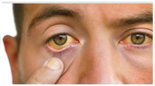 Skin Discoloration or Yellowish Pigmentation (Xanthoderma)