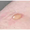 Yellowish Pimples or Bumps on the Skin (Xanthomas)