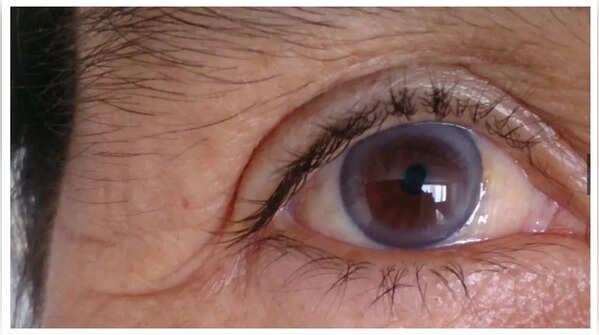 Gray or White Ring Around the Cornea (Corneal Arcus or Arcus Senilis)