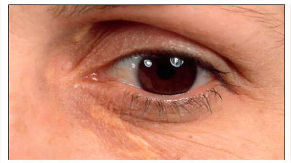 Yellow Patches Around the Eyelids (Xanthelasma)