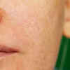 Targets pigmentation, sun tan and acne scars