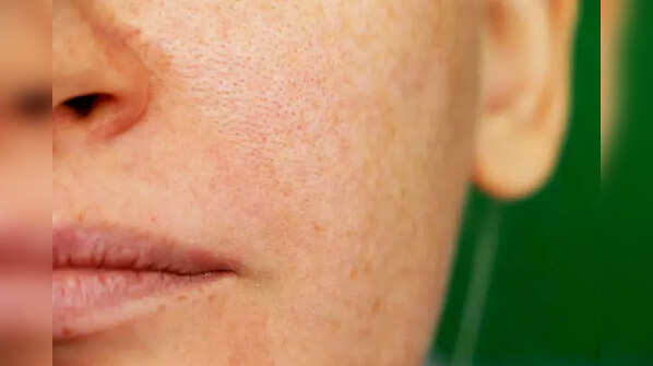 Targets pigmentation, sun tan and acne scars