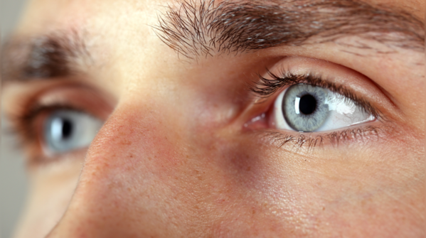 A soft, gray ring around the cornea (Arcus Senilis)