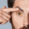 Small yellowish patches near the eyes 