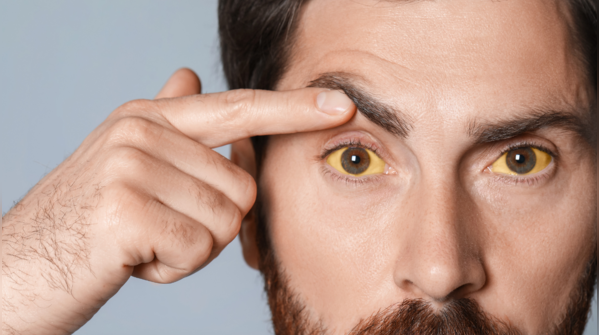 Small yellowish patches near the eyes