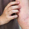 Persistent itchy or painful skin