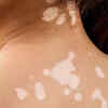 Unexplained skin discoloration