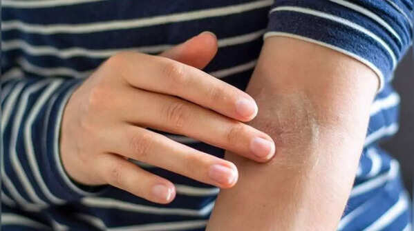 Persistent dry or crusty patches