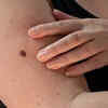 Changes in existing moles