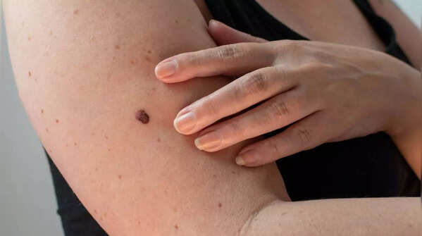 Changes in existing moles