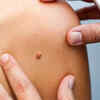New growths or lumps