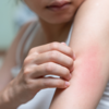 Itching 