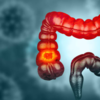 “Only unhealthy people get colon cancer”