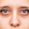 Sunken eyes