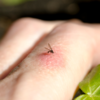 When a bite doesn't heal