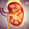 Uric acid complications